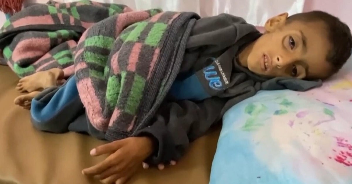 Cbsn fusion gaza doctor says lack of food and aid has led to catastrophic situation thumbnail.jpg