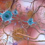Illustration alzheimers affected brain.jpg