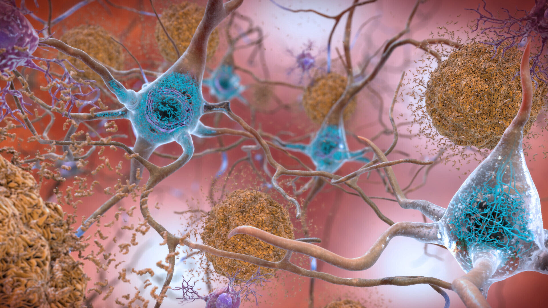 Illustration alzheimers affected brain.jpg
